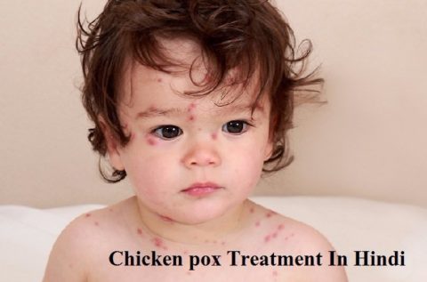चेचक का घरेलु इलाज, लक्षण, कारण | Chicken pox ka gharelu ilaj