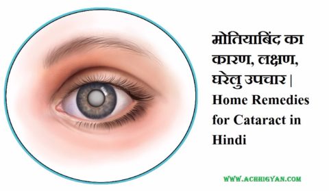 मोतियाबिंद का कारण, लक्षण, घरेलु उपचार | Home Remedies for Cataract in Hindi