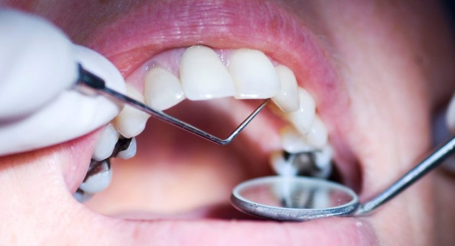 Tooth Decay Treatment in Hindi